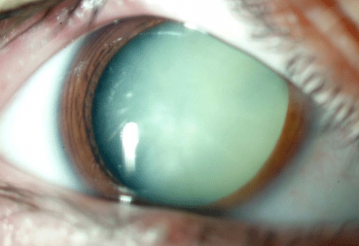 ¿Qué son las cataratas y cómo se forman en los ojos?
